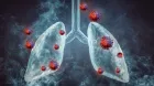 Lung Cancer