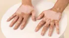 vitiligo